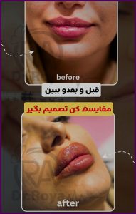 قبل و بعد تزریق ژل لب هالیوودی
