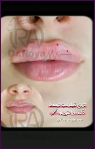 نمونه کارهای تزریق ژل لب هالیوودی