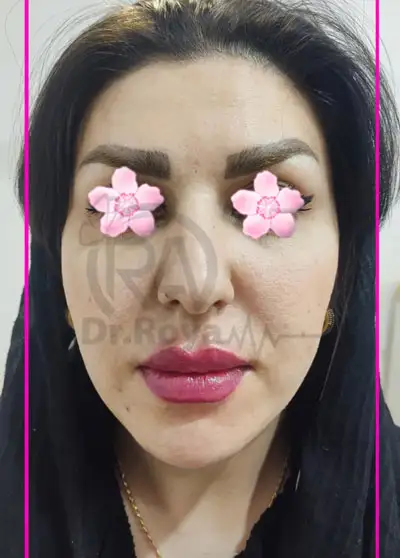 فیلر لب روسی در اصفهان