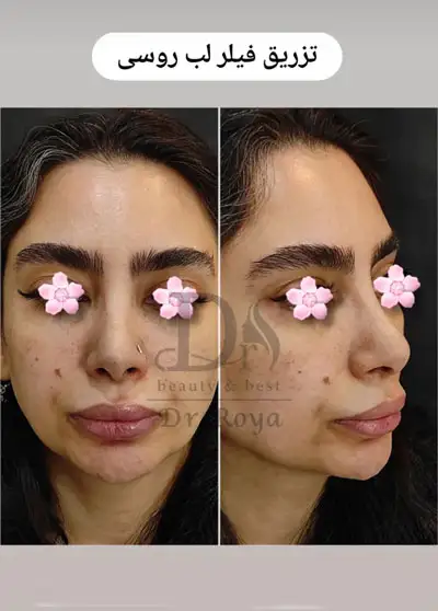 ژل لب روسی در اصفهان