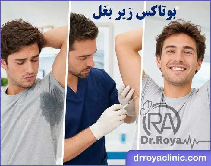 بهترین دکتر بوتاکس زیر بغل در اصفهان