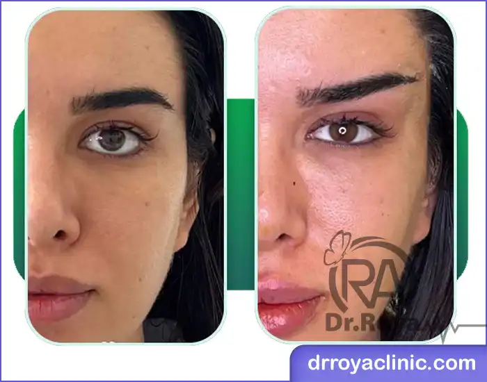 سوالات متداول لیفت ابرو در شهرکرد