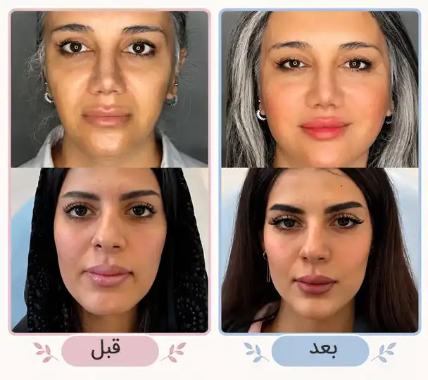 قبل بو بعد کلییک زیبایی تقی پور