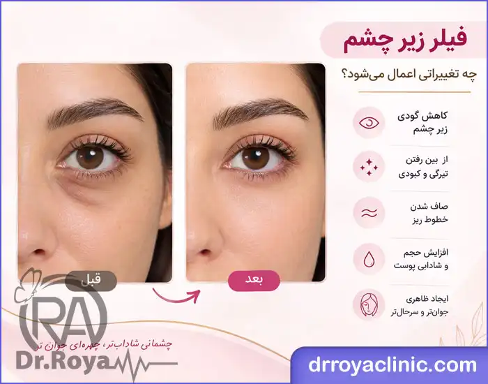 کاندید مناسب تزریق ژل زیر چشم در اصفهان