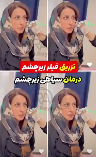 قیمت فیلر زیر چشم در اصفهان