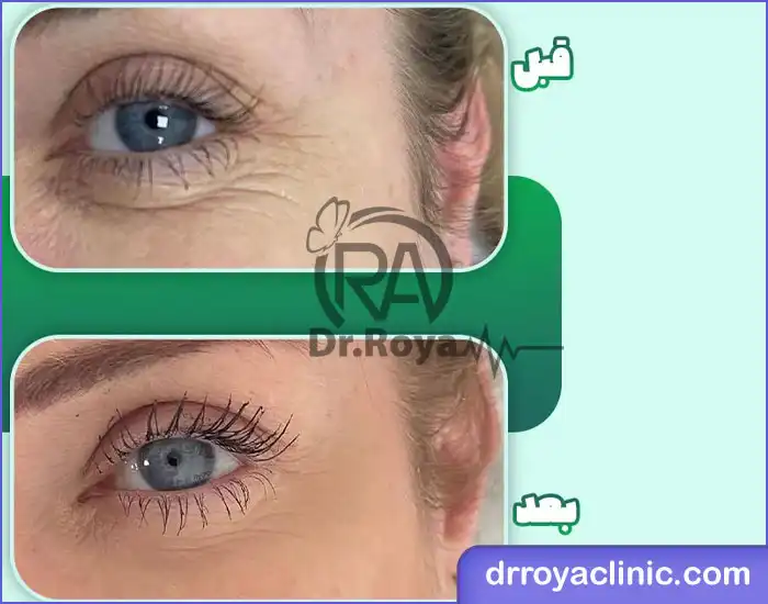 مراقبتهای قبل و بعد از تزریق مزوژل زیر چشم
