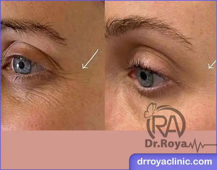 سوالات متداول درباره تزریق مزوژل زیر چشم در شاهین شهر
