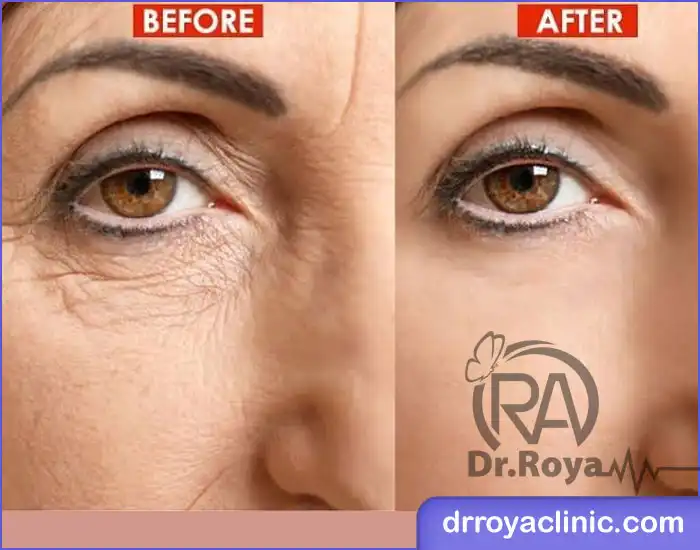 تزریق مزوژل زیر چشم چه مشکلاتی را بهبود میدهد؟