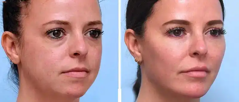 چگونه صورت گرد را به صورت طبیعی زاویه سازی کنیم؟