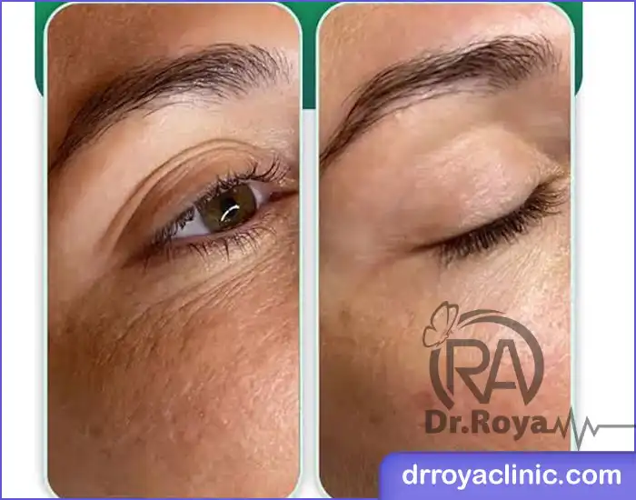 قیمت مزوژل زیر چشم در اصفهان