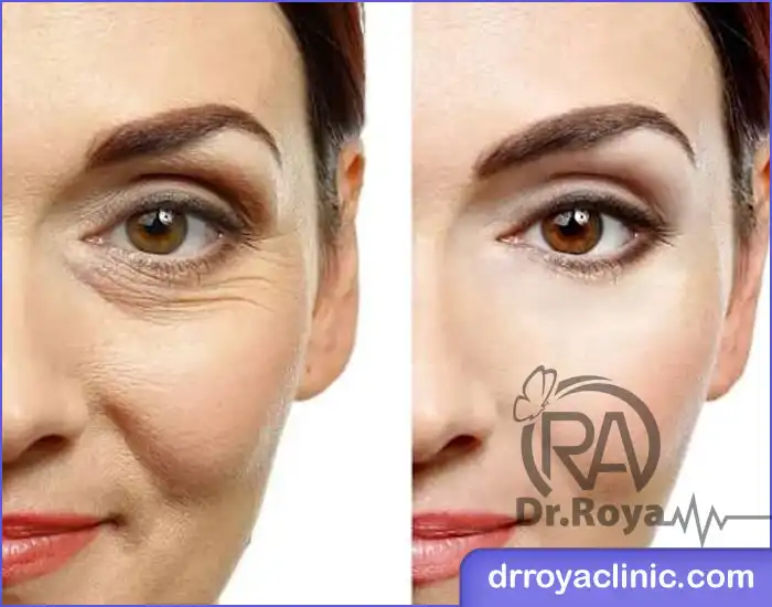 سوالات متداول درباره مزوژل زیر چشم در اصفهان
