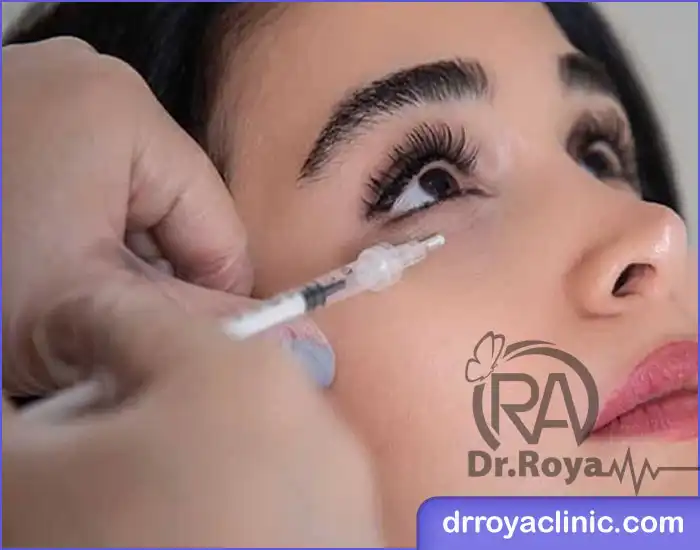 مزوژل برای کدام نوع تیرگی زیر چشم مناسب است